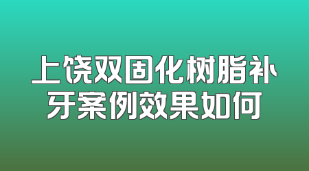 上饶双固化树脂补牙案例效果如何