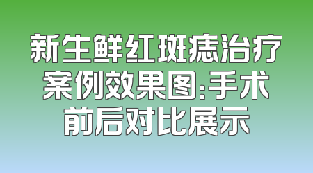 新生鲜红斑痣治疗案例效果图：手术前后对比展示