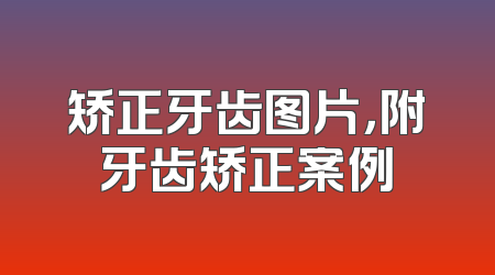 矫正牙齿图片，附牙齿矫正案例