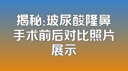 揭秘：玻尿酸隆鼻手术前后对比照片展示