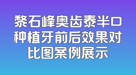 黎石峰奥齿泰半口种植牙前后效果对比图案例展示