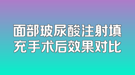 面部玻尿酸注射填充手术后效果对比