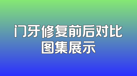 门牙修复前后对比图集展示