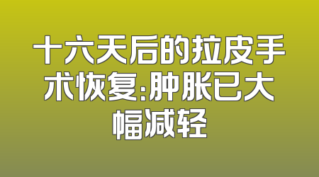 十六天后的拉皮手术恢复：肿胀已大幅减轻