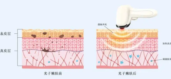 光子嫩肤一次（单次）治疗的价格